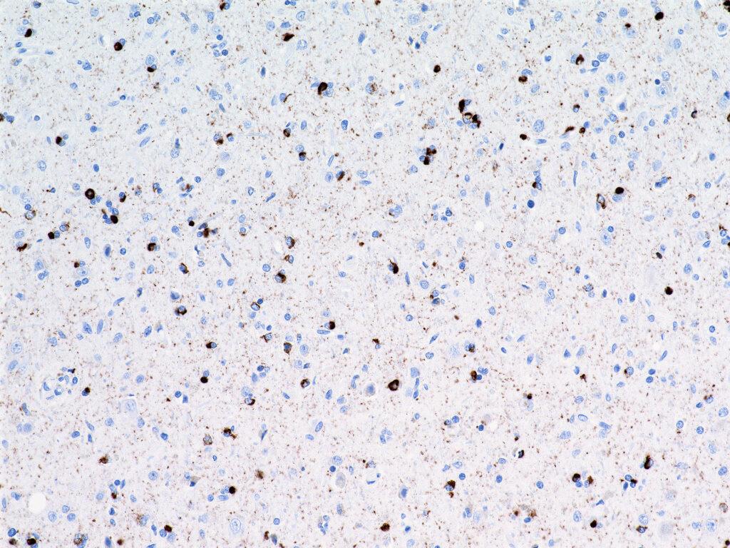 ALSRiluzol ALSAmbulanz