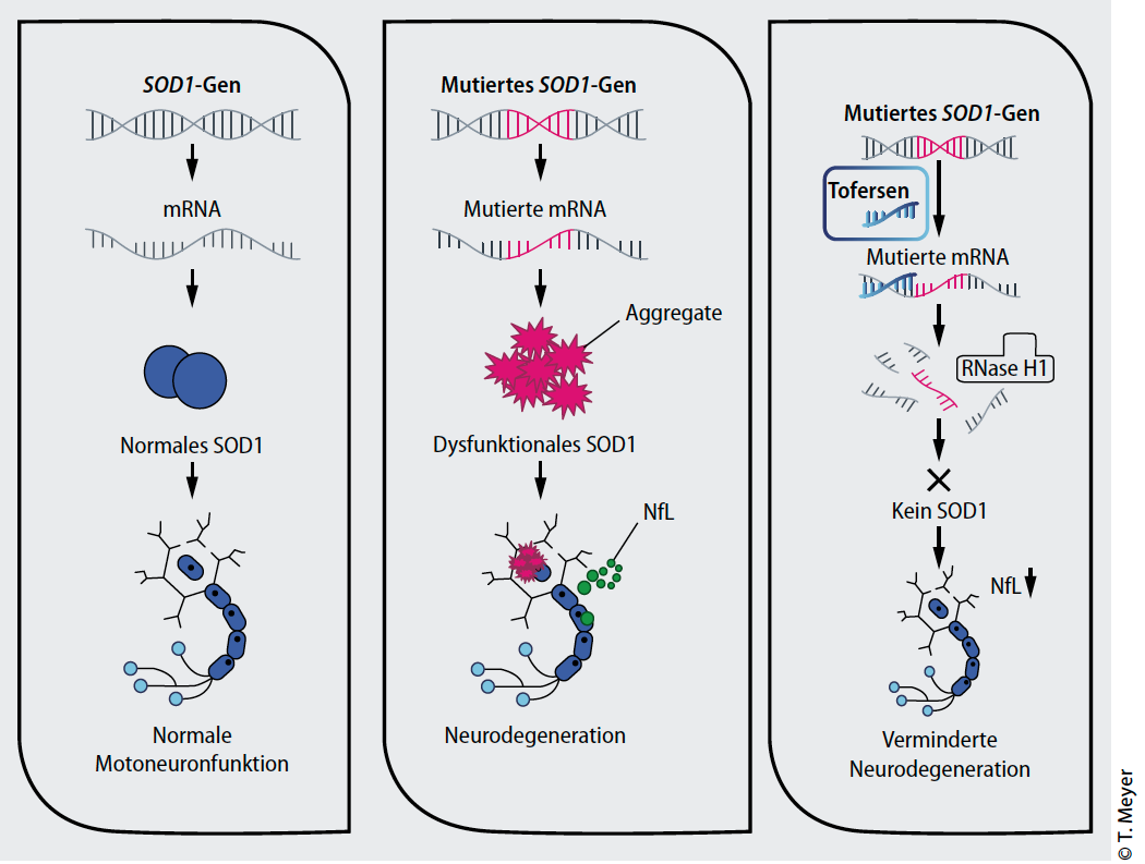 amyotrophe-lateralsklerose-als-SOD1-Therapie-tofersen