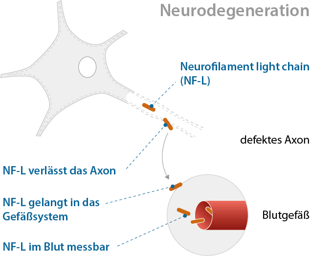 amyotrophe-lateralsklerose-als-neurofilament-nfl