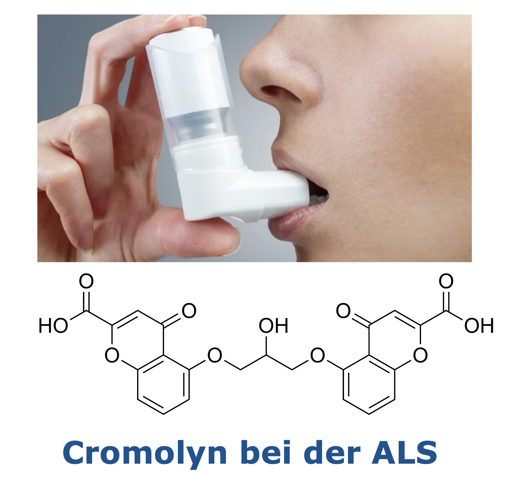amyothrophe-lateralsklerose-als-charite-als-ambulanz-berlin-studie-cromolyn